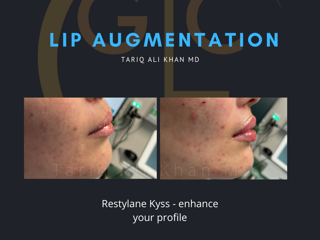 Gentle Care Laser Tustin & Long Beach Before and After picture - Lip Augmentation